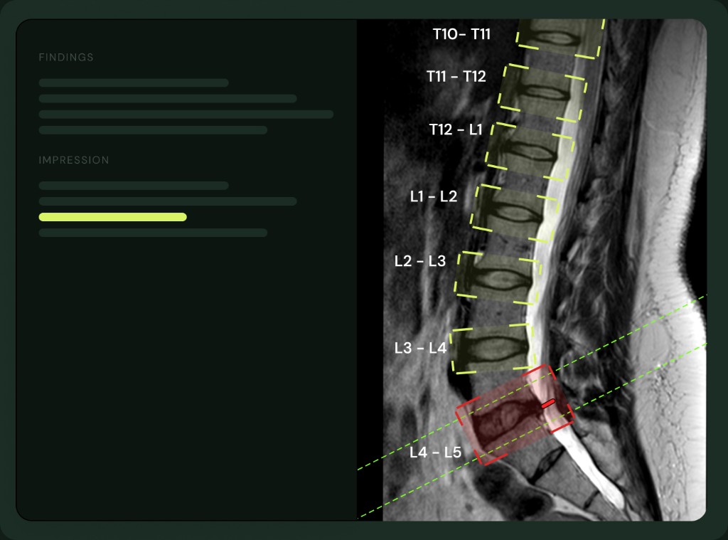 MRI of lumbar spine with AI-labeled vertebrae levels in Medsee report