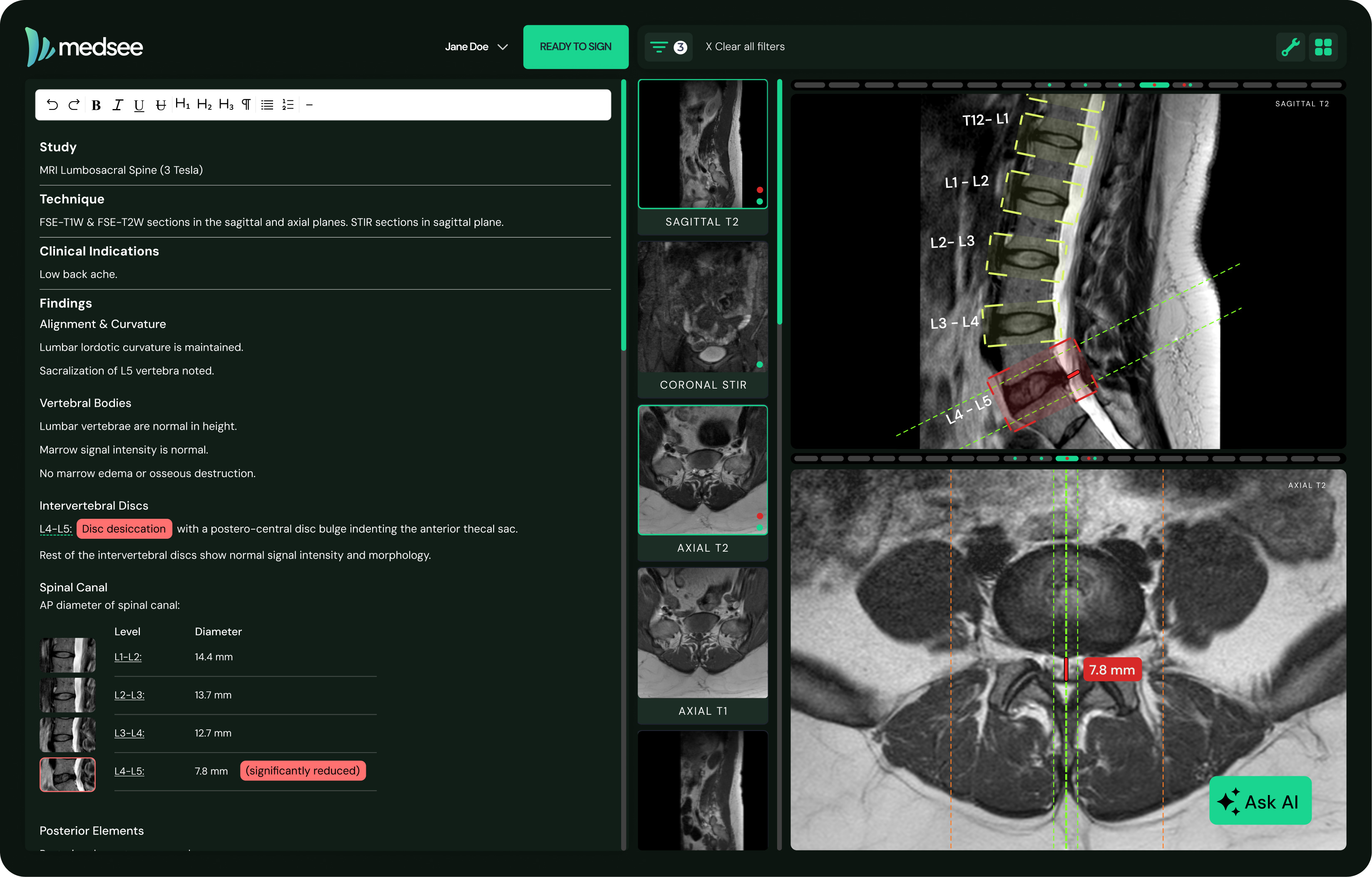 Medsee interactive radiology report interface showing evidence-linked findings